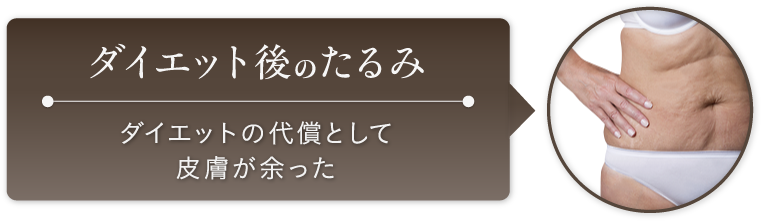 ダイエット後のたるみ:ダイエットの代償として皮膚が余った