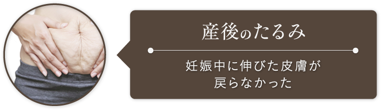 産後のたるみ:妊娠中に伸びた皮膚が戻らなかった